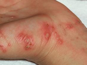 疥疮的发病因素通常有哪些？