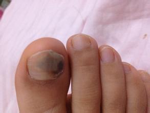 灰指甲患者在早期会出现哪些症状