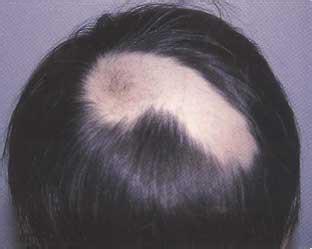 斑秃有哪些主要的危害