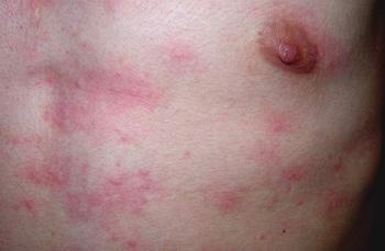 过敏性荨麻疹该如何进行护理？