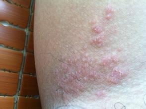 亚急性湿疹发病的原因有哪些