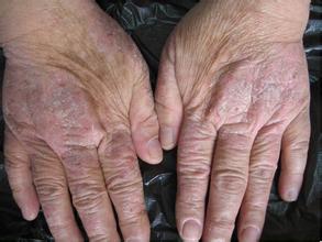 导致手部湿疹加重的原因是什么？