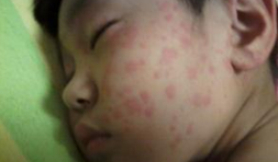 导致过敏性荨麻疹发病的原因