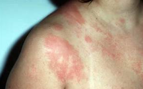几种常见类型的皮炎损害性