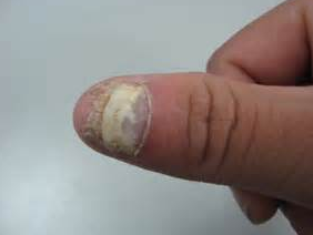 我们来看看灰指甲的具体病因