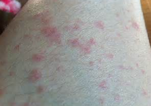 急性湿疹的病发特点是怎么样的呢
