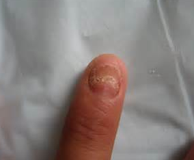 灰指甲的治疗方法有哪些