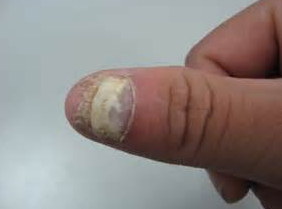 怎么防止感染上灰指甲呢