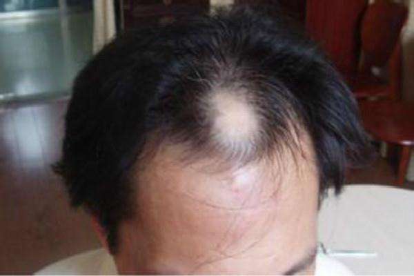 郑州哪里有治疗脱发的