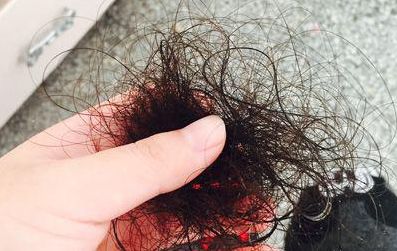 郑州肤康专业治脱发，如何科学的护理头发