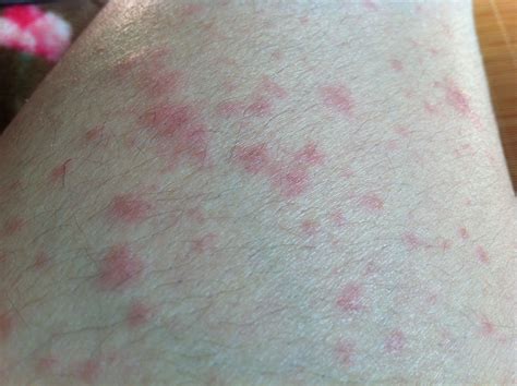 湿疹容易与哪些皮肤病混淆