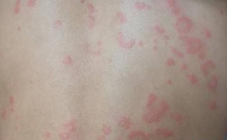日常生活中荨麻疹的常见症状